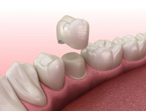 What is a dental crown